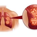 CyberKnife Stereotactic Radiosurgery Is Ideal Treatment For Lung Cancer