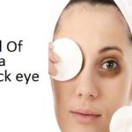 How to Get Rid of a Black Eye